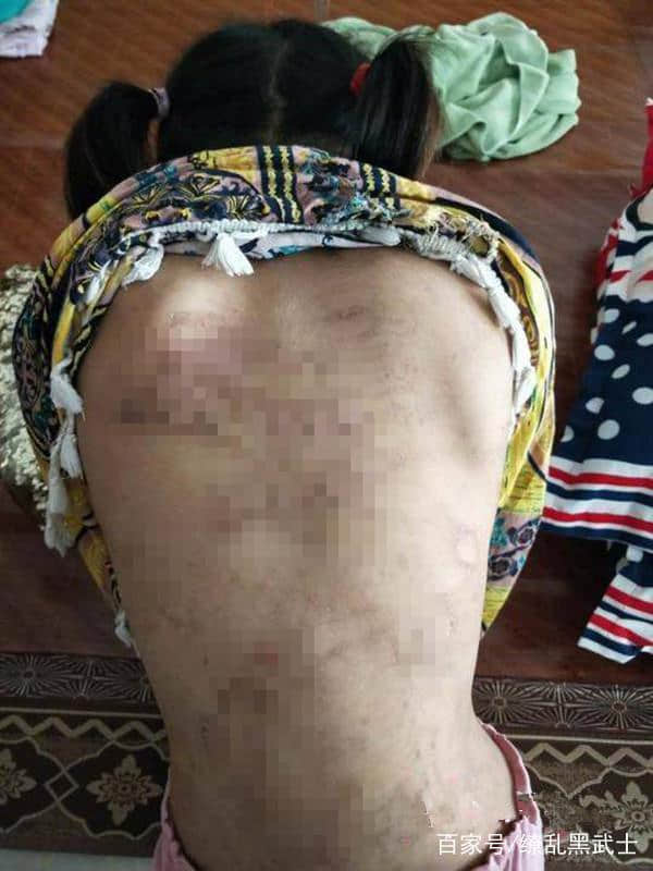 12岁女儿童内衣_又现百草枯！湖北12岁女童误将百草枯当止咳药喝下